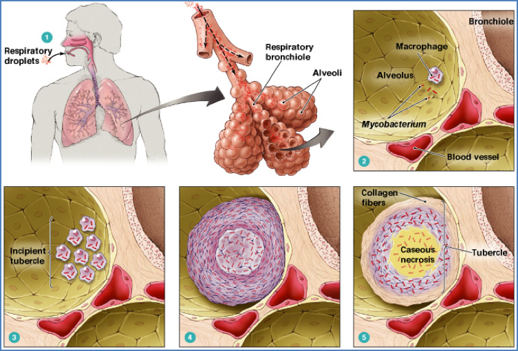 PULMONARY TUBERCULOSIS