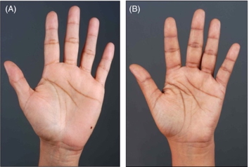 Palmar Crease Pigmentation