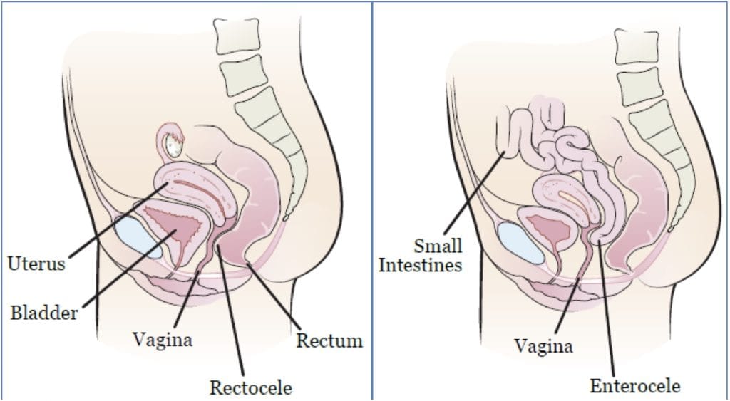 pelvic organ prolapse: Posterior Prolapses