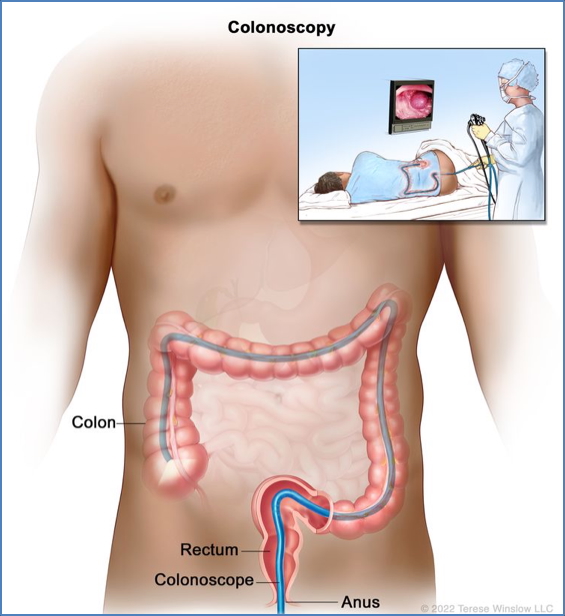 Colorectal Cancer Prevention