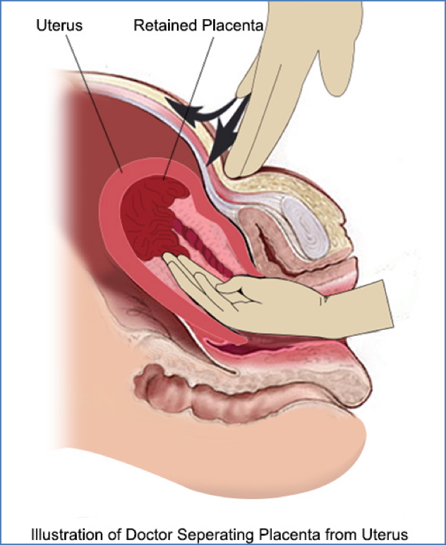 RETAINED PLACENTA