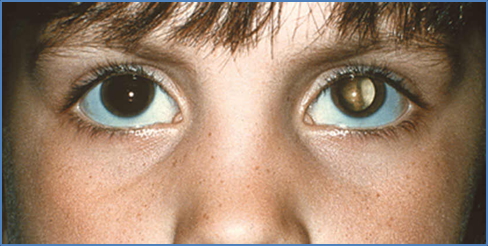 RETINOBLASTOMA