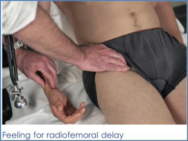 the cardiovascular examination: Radio-Femoral-Delay
