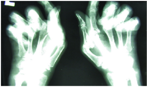 the rheumatological examination: Rheumatoid Arthritis