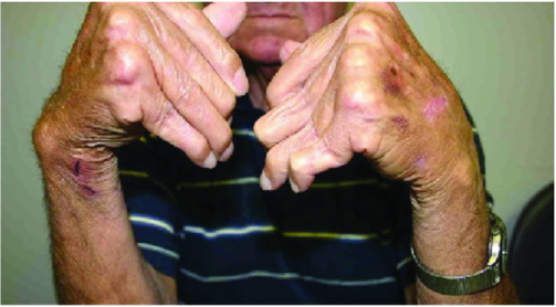 the rheumatological examination: Rheumatoid Arthritis