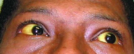 Scleral Icterus
