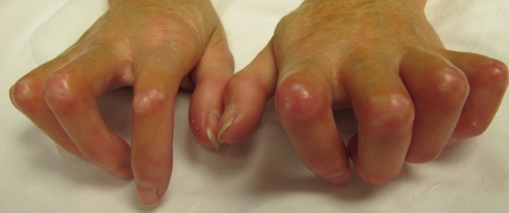 the rheumatological examination: Scleroderma