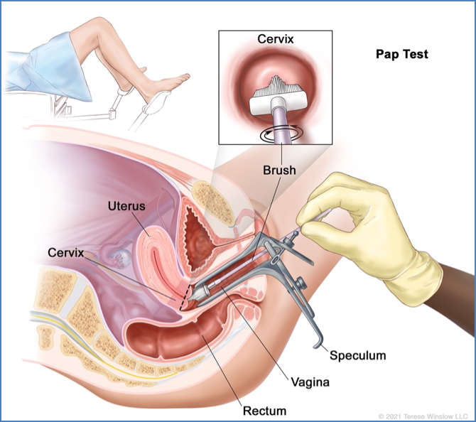 well-woman check: Speculum Examination & Pap Smear