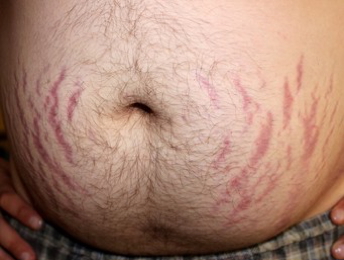 the endocrine examination: Striae