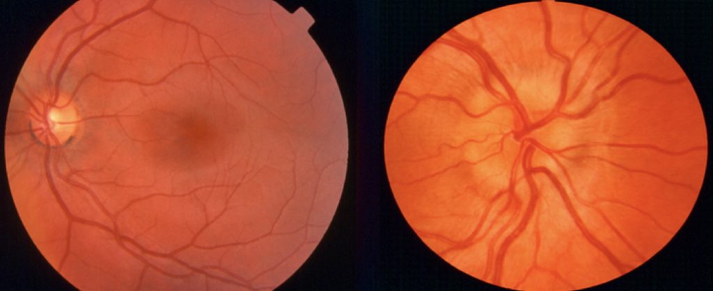ophthalmoscopy technique: Swollen Disc