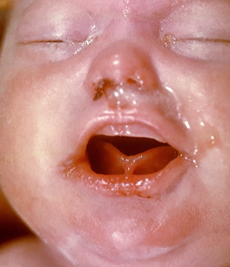 Syphilis in Pregnancy