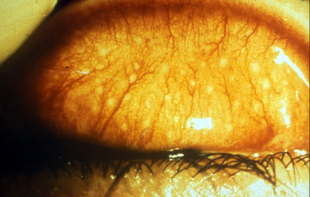 trachoma: Trachomatous Inflammation