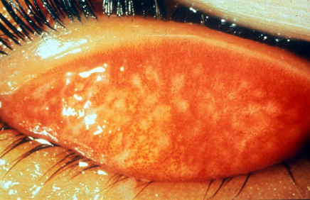 trachoma: Trachomatous Inflammation