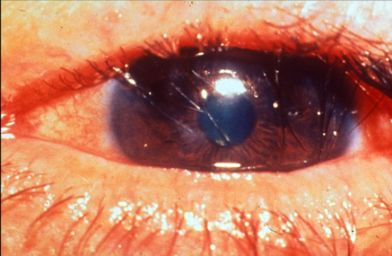 trachoma: Trachomatous Trichiasis