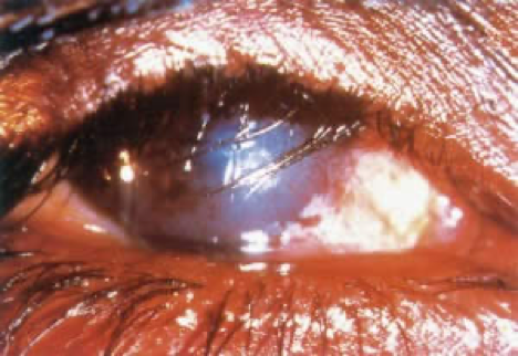 Corneal Opacity
