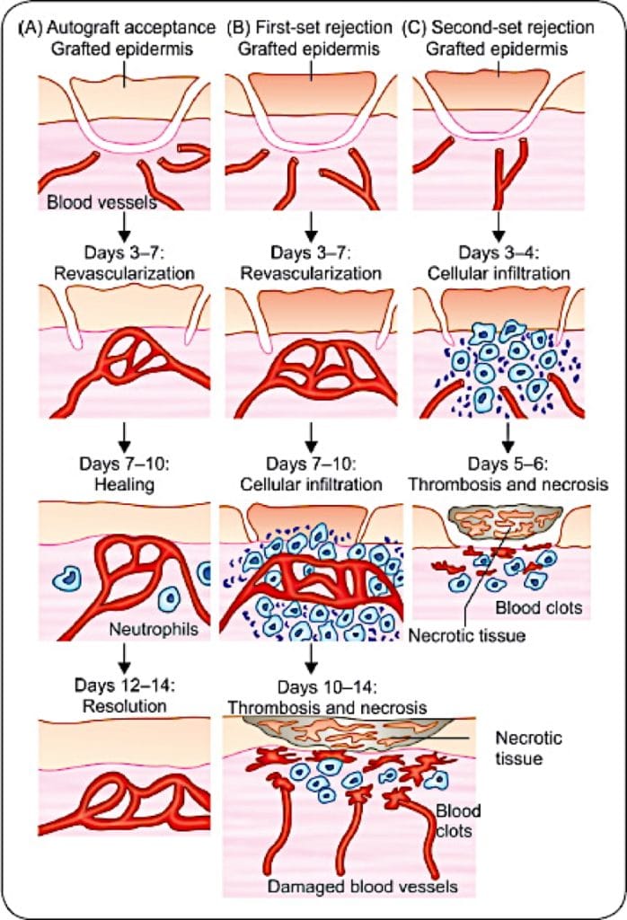 transplant immunology: The Central Role of T-Cells in Rejection