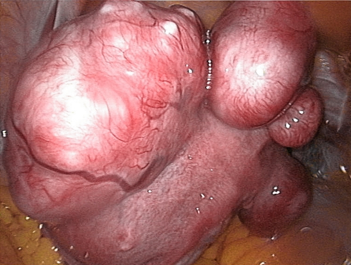 UTERINE FIBROID