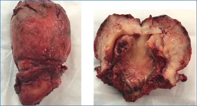 Uterine Cancers: UTERINE LEIOMYOSARCOMA