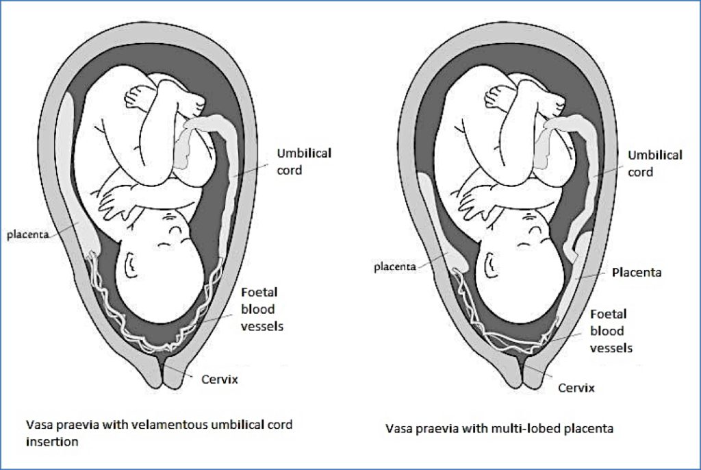 obstetrical haemorrhage: VASA PREVIA