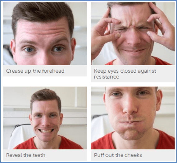 VII – Facial Nerve