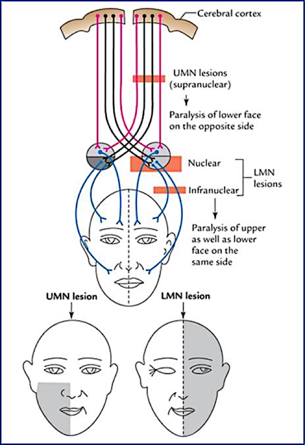 VII – Facial Nerve