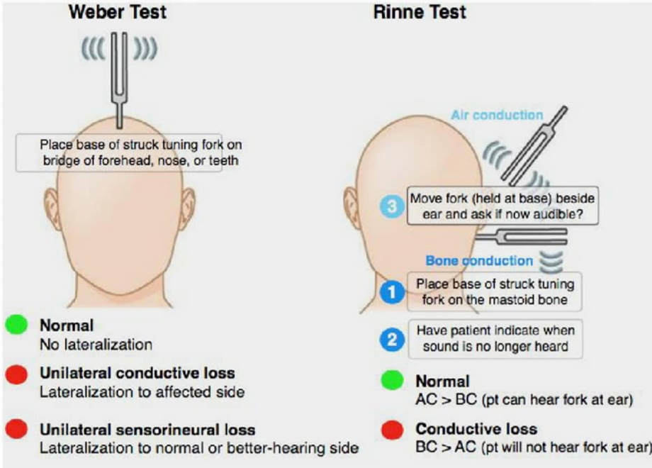 VIII – Vestibulocochlear Nerve