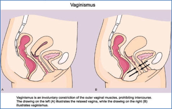 sexual dysfunctions: Vaginismus